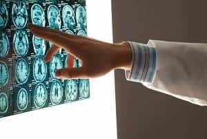 b2ap3_thumbnail_brain-injury-concussion-head-trauma-1.jpg